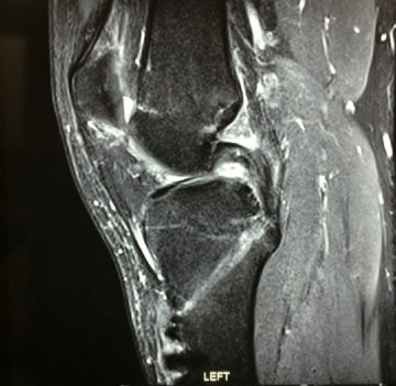 Knee — PCL tears - Avalon Orthopaedic